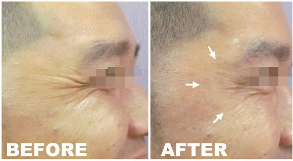 botox and filler injections