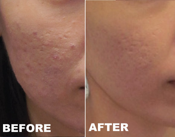 laser treatment