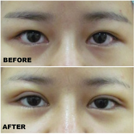 Double Eyelid