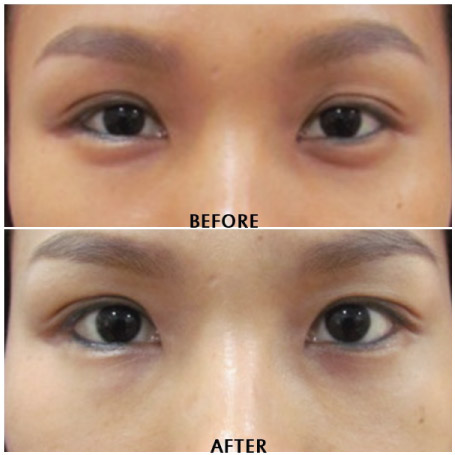Eye Bag Removal