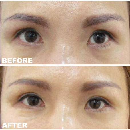 botox and filler injections