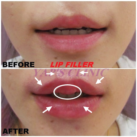 Lip Filler