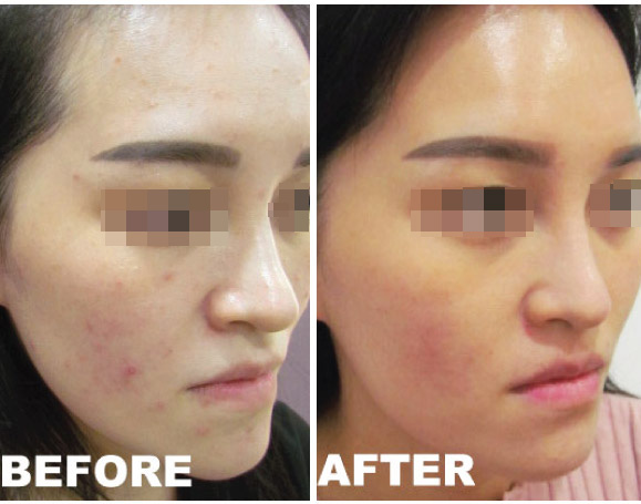 laser treatment