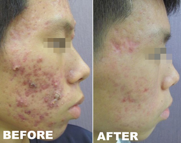 laser treatment