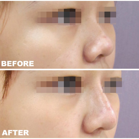 botox and filler injections